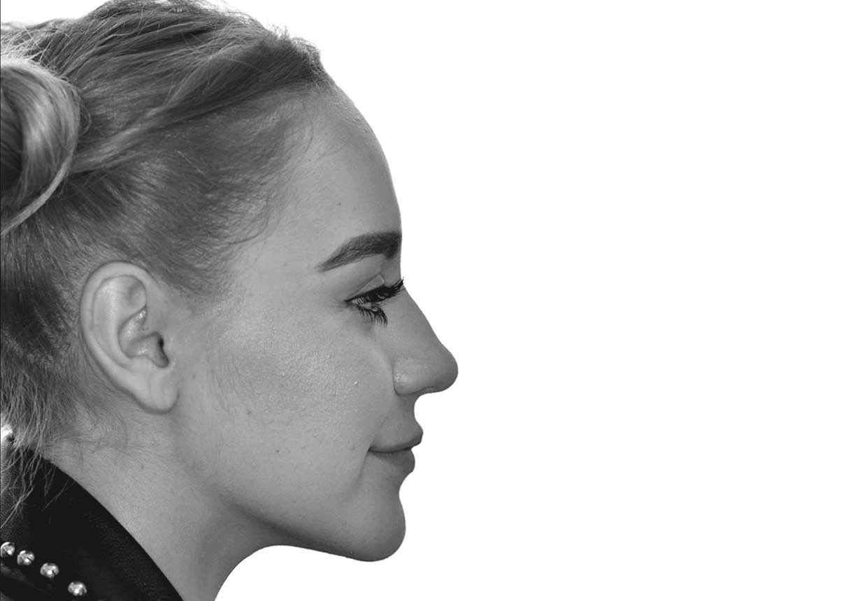 Perfil facial, cirugía ortognática