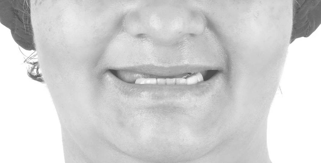 Antes del implante dental