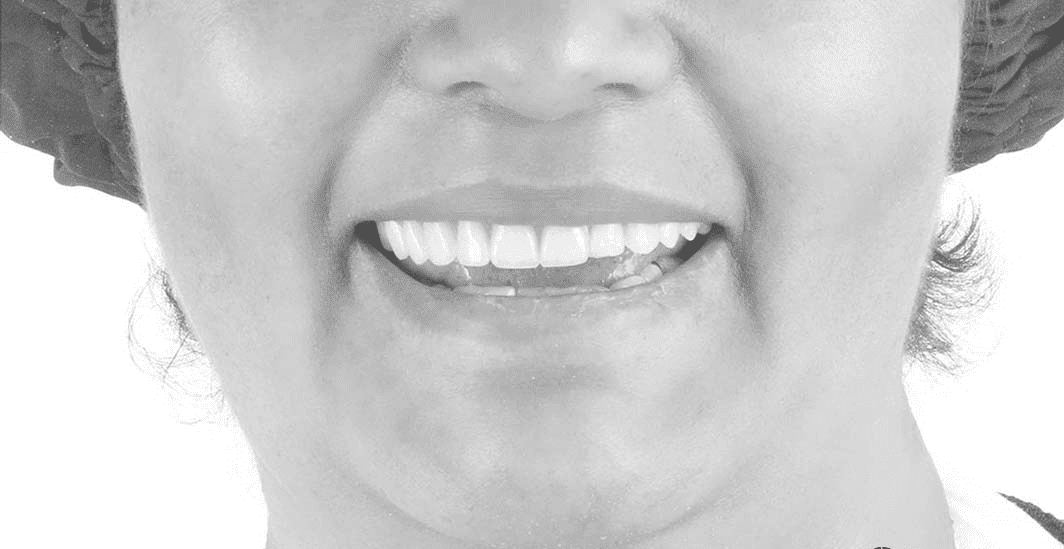 Después del implante dental