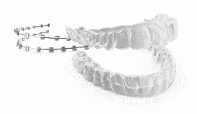 Invisalign