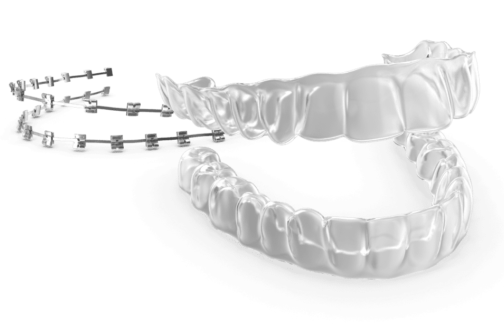 procedimiento braquets Invisalign